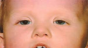 Epicanto: es un pliegue vertical en el ángulo interno del ojo. Se ve en  algunas razas asiáticas y en personas con síndrome de Down.