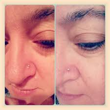 Nose Piercing Bump Before And After Nose Piercing Bump Piercing Bump Nose Piercing
