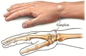 Qui trovi opinioni relative a sporgenza e puoi scoprire cosa si pensa di sporgenza. Cisti Gangliari E Tendinee Centro Medico Esculapio