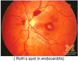 Roth S Spot Ie Retinal Photography Optometry Eye Anatomy