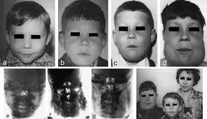 Affected children appear normal at birth. Familial Cherubism The Experience Of The Moscow Central Institute For Stomatology And Maxillo Facial Surgery International Journal Of Oral And Maxillofacial Surgery