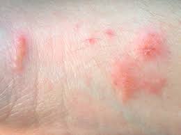 Urushiol Induced Contact Dermatitis Wikipedia