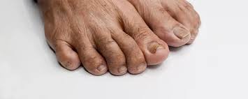 Image result for toe black diabetes
