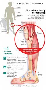 La douleur au talon ou sur le tendon révèle toujours une erreur plus générale. Des Ondes De Chocs Contre Les Tendinites