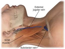 Image result for Peripheral IV Access