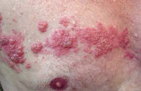 Image result for skin rash acute hiv infection