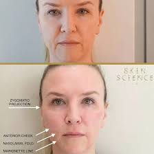 Nose to Mouth Lines Treatment