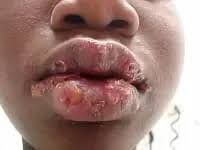 Image result for Oral herpes roof of mouth