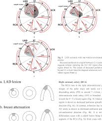 As seen, coronary artery anomalies may involve abnormalities of number, origin and/or course, termination, or structure of the epicardial coronary coronary angiography showing the presence of a fistula originating from a diagonal (diag) branch of the left anterior descending coronary artery with. Pdf Basics Of Reading Myocardial Perfusion Spect To Identify Coronary Artery Lesions Semantic Scholar