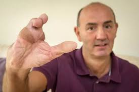 A Sevenoaks dad whose fingers were replaced with toes after an horrific  accident returns to East Grinstead to thank the surgeon