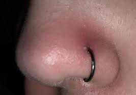 Is Redness And Swelling Normal After Switching Out My Nose Stud For A Hoop Piercing