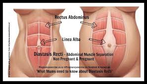 We did not find results for: Diastasis Recti What Women Need To Know Pregnancy