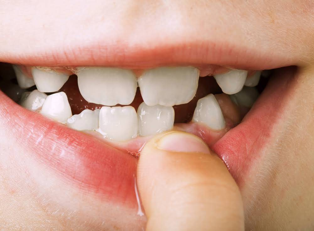 Traumatics Dental Injuries product image