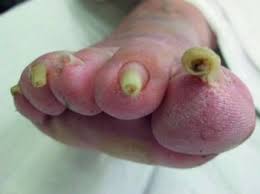 About 5% of hyperthyroid patients display abnormal nail changes. Deformaciones Y Distrofias De Las Unas Trastornos Dermatologicos Manual Msd Version Para Profesionales