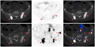 Give them tacos who said we're just burger. Diagnostics Free Full Text 68ga Psma 11 Pet Ct Follow Up Of Patients With Prostate Cancer With Bone Metastases Who Had Reduced Bone Density After Androgen Deprivation Therapy Html