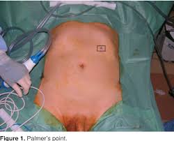 Palmer's point, located in the left upper quadrant, has been reported as an alternative access site for pelvic laparoscopy to reduce morbidity, but not widely reported among urologists. Primary Left Upper Quadrant Palmer S Point Access For Laparoscopic Radical Prostatectomy Semantic Scholar