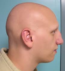 Alopecia areata universalis is the loss of hair over your entire body. Treatment For Alopecia Totalis And Alopecia Universalis