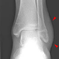 Ankle joint recess with fluid. Skeletal Trauma