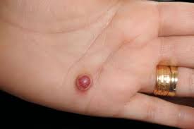 Image result for Pyogenic Granuloma