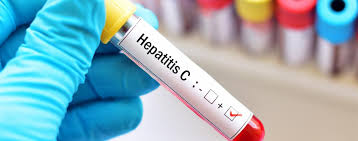 Each have different hepatitis symptoms and. Hepatitis C Focus Arztsuche