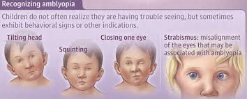 Image result for Amblyopia