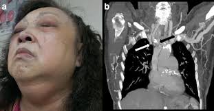 ExPRESS miniature glaucoma shunt for intractable secondary glaucoma in  superior vena cava syndrome