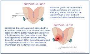 Bartholin's Gland Cyst Home Treatment – Sitzbath Solution
