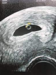 Us 6 Woche Kein Herzschlag Schwangerschaftsgruppe Babycenter