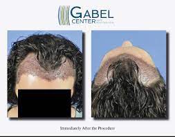 80% results will be seen in 8 to 9 months. Watch A Patient S Real Time Growth After 3439 Grafts Gabel Center