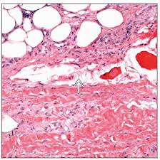 Image result for Lipodermatosclerosis