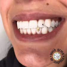Pin On Tooth Gems