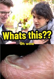 Image result for Koilonychia feet