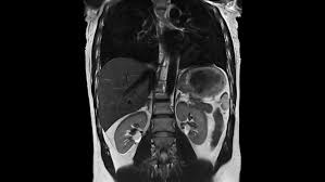 Image result for Incidental Imaging Finding