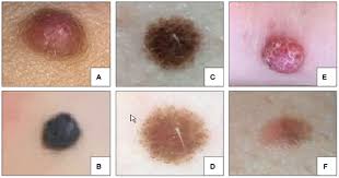 Image result for Spitz Nevus