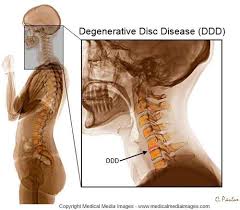 Color X Ray Of The Cervical Spine Showing Degenerative Disc Disease Ideal For Websites And Publications Degenerative Disc Cervical Degenerative Disc Disease