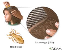 Image result for lice vs nits