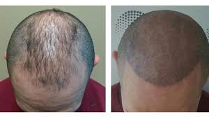 How will this medication effect my sperm count and also will my sperm have this medicine in them. Receding Hairline 7months On Dutasteride And Minoxidil Practo Consult