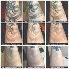 Laser tattoo removal techniques can get rid of your unwanted tattoo with minimal side effects. My 2 Year Progress So Far You Can See After The 5th Session Is When I Started Getting Hyper Pigmentation The Tattoo Turned Into A Brown Blob Taking Some Time Off From