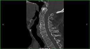 Spine Case C1 C2 Fracture With Atlantoaxial Subluxation