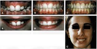 Performing Smile Analysis and Design with Digital Technology