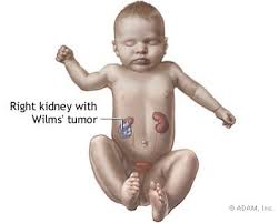 These cells are irregular in shape and work since they are not yet fully formed and matured. Wilms Tumor Physiopedia