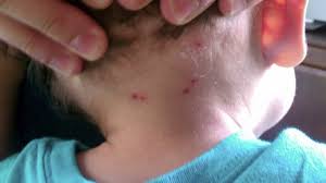 Rickettsia, una enfermedad fatal que se confunde con la gripe