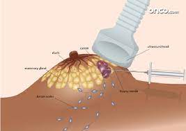 Approaching someone with breast cancer is difficult. Know All About Breast Cancer Biopsy Onco Com