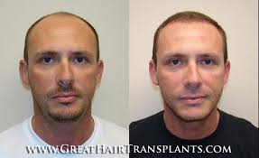 Hair Treatment Cost For Men And Women in New York Monroe Whipple Park