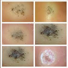 Salicylic acid is highly effective in warts treatment, along with different kinds of skin treatments out there. Plantar Wart Progression Description In Comments Warts