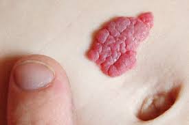Blutschwammchen Und Feuermale Gesund Co At