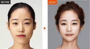 Everything You Need To Know About Double Jaw Surgerymedisetter
