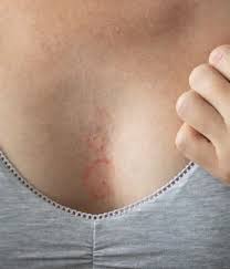 Image result for Inflammatory breast cancer