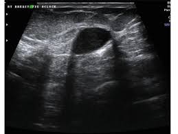 Inflammatory breast carcinoma is a rare type of invasive ductal carcinoma, which mimics an infection or mastitis at presentation. Benign And Malignant Characteristics Of Breast Lesions At Ultrasound Radiology Reference Article Radiopaedia Org