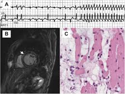 Myocarditis is a disease marked by the inflammation of the heart muscle known as the myocardium — the muscular layer of the heart wall. Eosinophilic Myocarditis In A Patient With Multiple Myeloma Clinical Lymphoma Myeloma And Leukemia